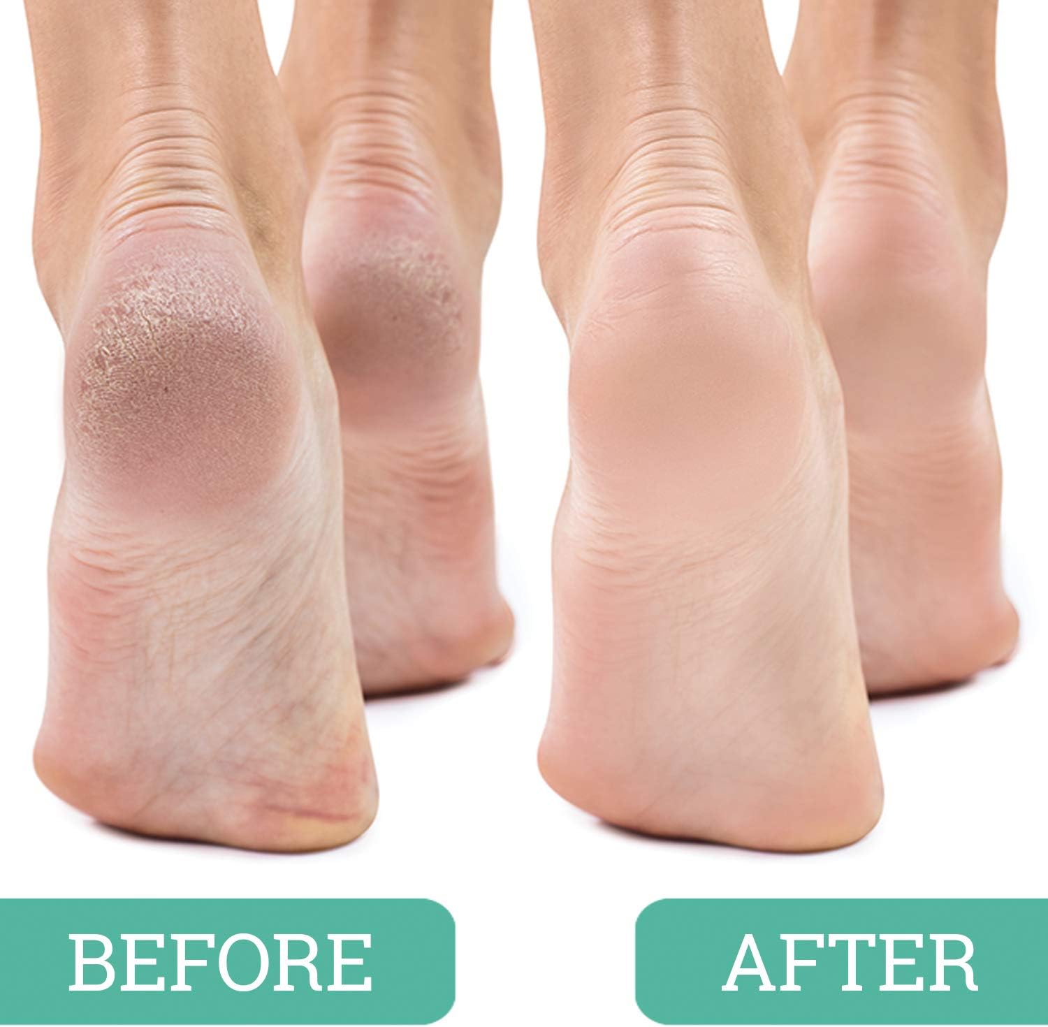 Salon Foot Pumice and Scrubber for Feet and Heels Callus and Dead Skins, Safely and Easily Eliminate Callus and Rough Heels (Pack of 4)