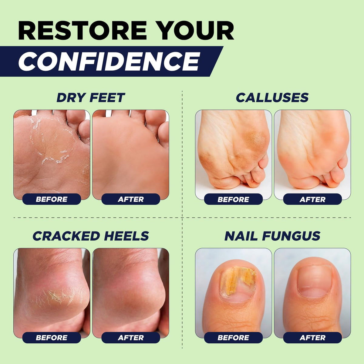 Tea Tree Callus Remover Gel &amp; Foot Soak, Foot Cream for Dry Cracked Feet