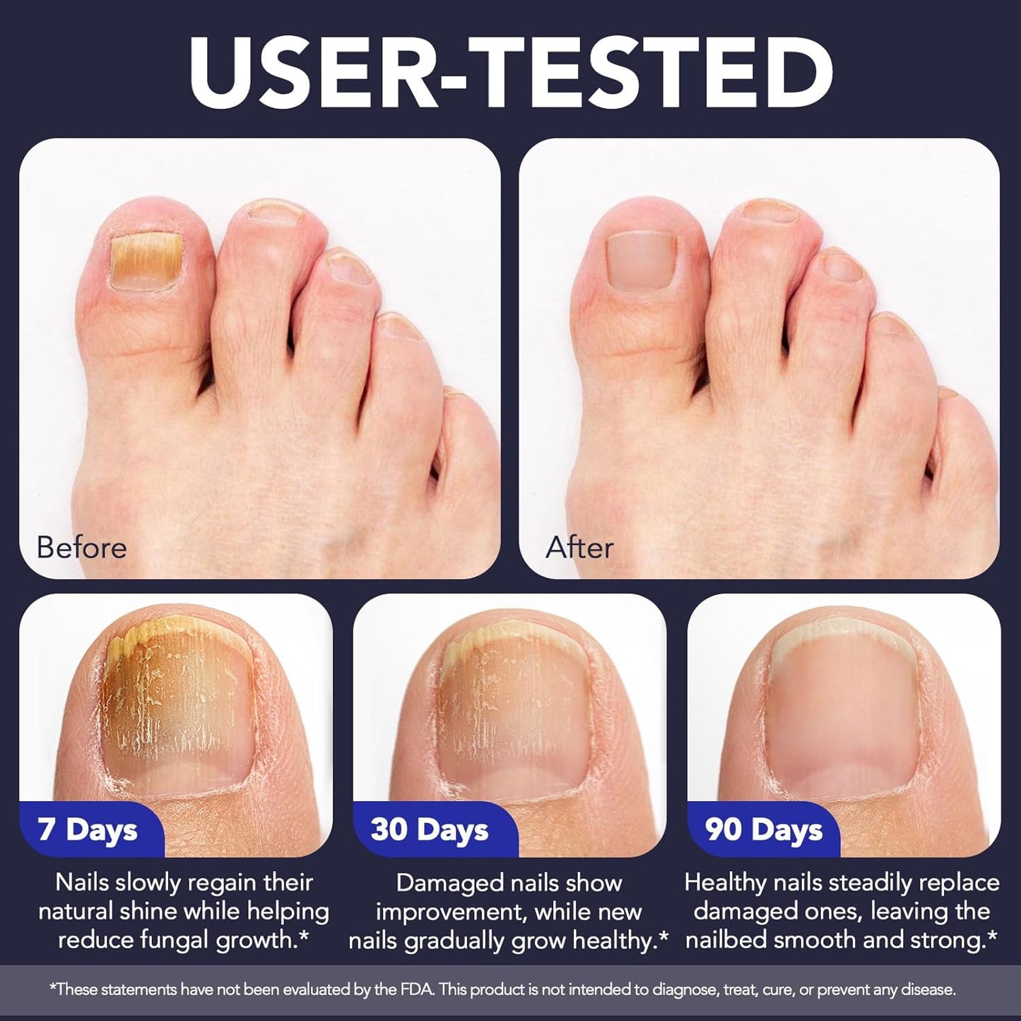 Toenail Fungus Treatment Extra Strength, Nail Fungus Pen, 25% Undecylenic Acid with added Tea Tree Oil, Jojoba, Clove Bud Oils & Aloe, Fast-Acting Solution for Toe & Fingernail Fungi, 5PCS