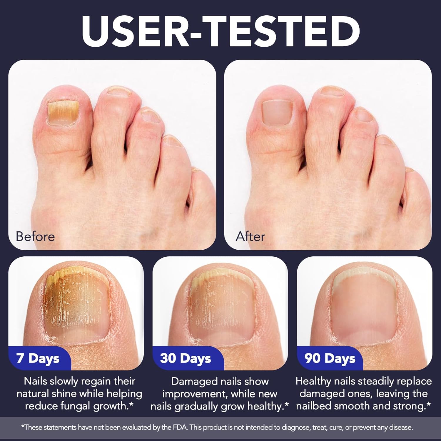 Toenail Fungus Treatment Extra Strength, Nail Fungus Pen, 25% Undecylenic Acid with added Tea Tree Oil, Jojoba, Clove Bud Oils & Aloe, Fast-Acting Solution for Toe & Fingernail Fungi, 5PCS