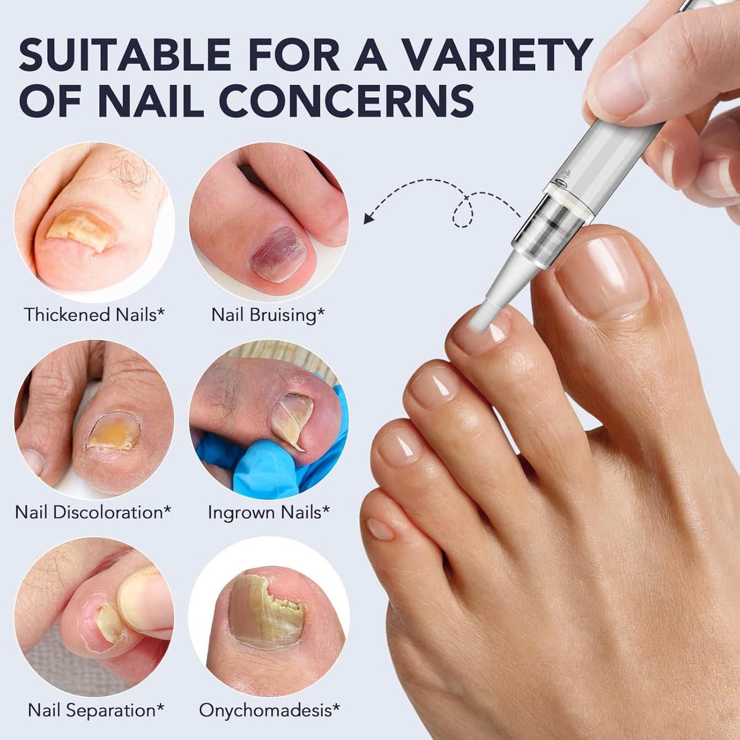 Toenail Fungus Treatment Extra Strength, Nail Fungus Pen, 25% Undecylenic Acid with added Tea Tree Oil, Jojoba, Clove Bud Oils & Aloe, Fast-Acting Solution for Toe & Fingernail Fungi, 5PCS