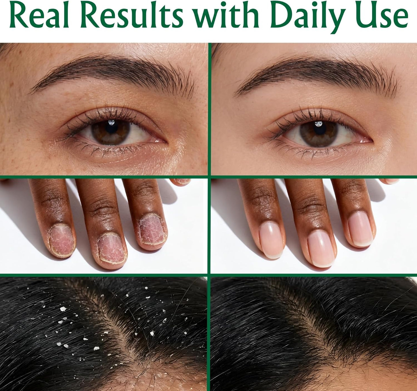 BodyJ4You Tea Tree Oil for Skin Hair - USDA Organic Essential Oils Pre-Diluted MCT - Melaleuca Face Scalp Nails Feet Toenail Cuticle - Pure Natural Topical Ready to Use Vegan Hexane Free - 2 Fl Oz