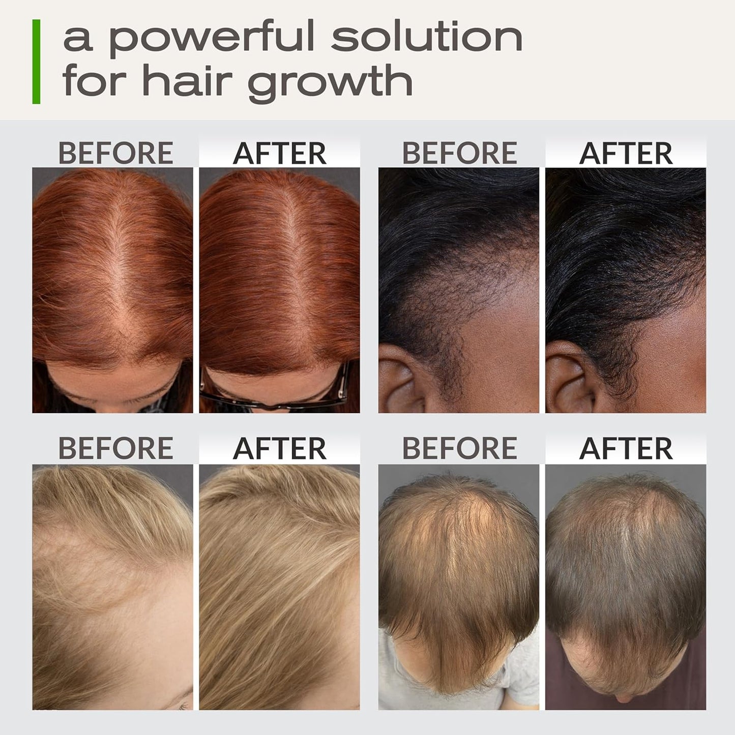 Ella & Eden Hair Growth Oil with Rosemary, Castor, Peppermint Oils & Biotin - Dry Scalp Treatment - Strengthening, Repairing, Soothing - 2 Fl Oz Glass Bottle